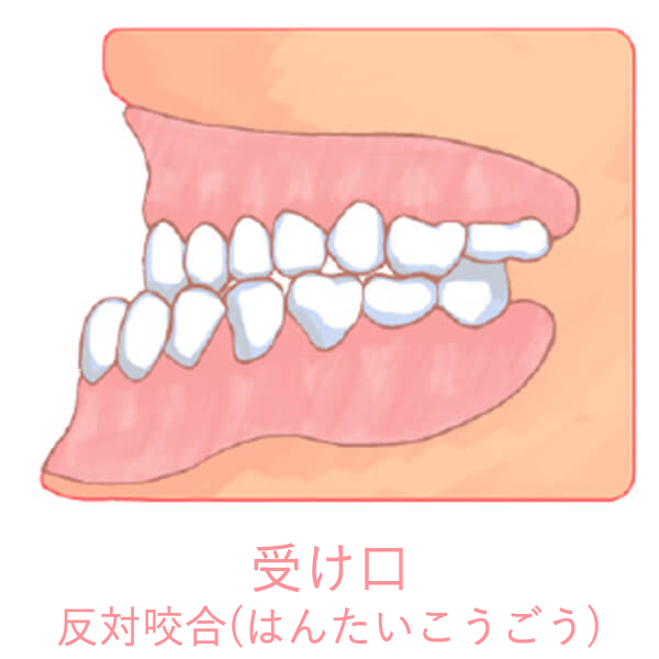 反対咬合