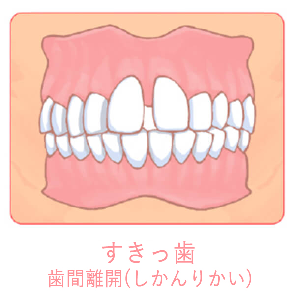 歯間離開