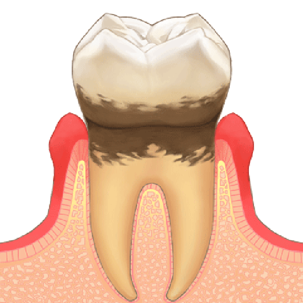 軽度歯周病