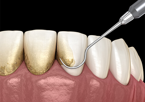 歯石の除去
